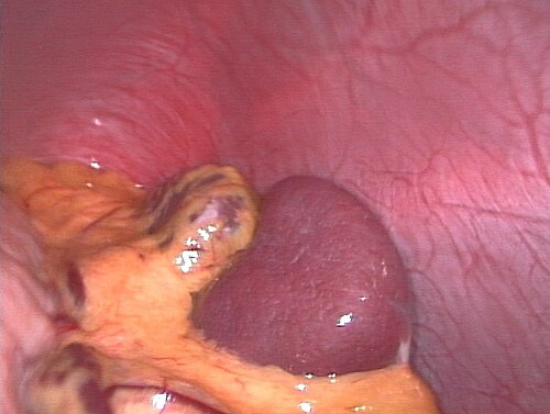 ヒト脾臓の腹腔鏡像