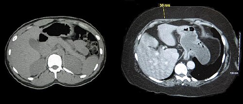 腹部中央部の水平断面の 2 つのコンピュータ断層撮影画像。1 つは標準体重の人、もう 1 つは肥満の人です。どちらも骨構造と臓器は似ています。主な違いは、標準体重の人には皮下脂肪がほとんどなく、肥満の人には皮下脂肪がかなりあることです。