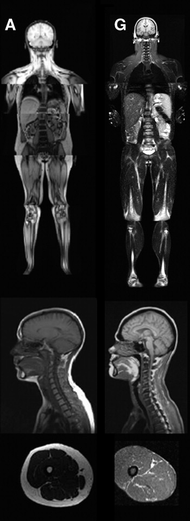 対照患者と罹患患者の MRI。