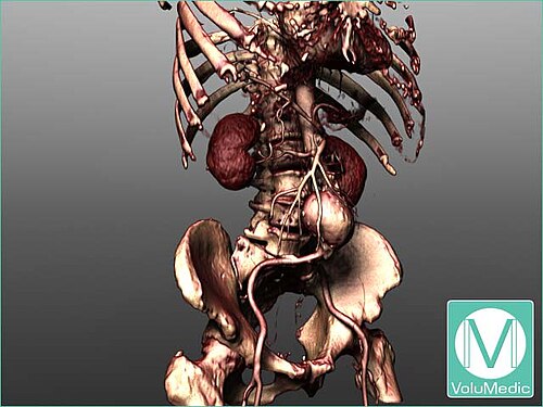 VoluMedicソフトウェアを用いて、腹部大動脈瘤患者のCT血管造影画像をレンダリングした。