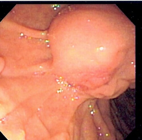 内視鏡的逆行性胆管膵管造影（ERCP）時に、ファーター乳頭部に嵌頓した総胆管結石が認められた。